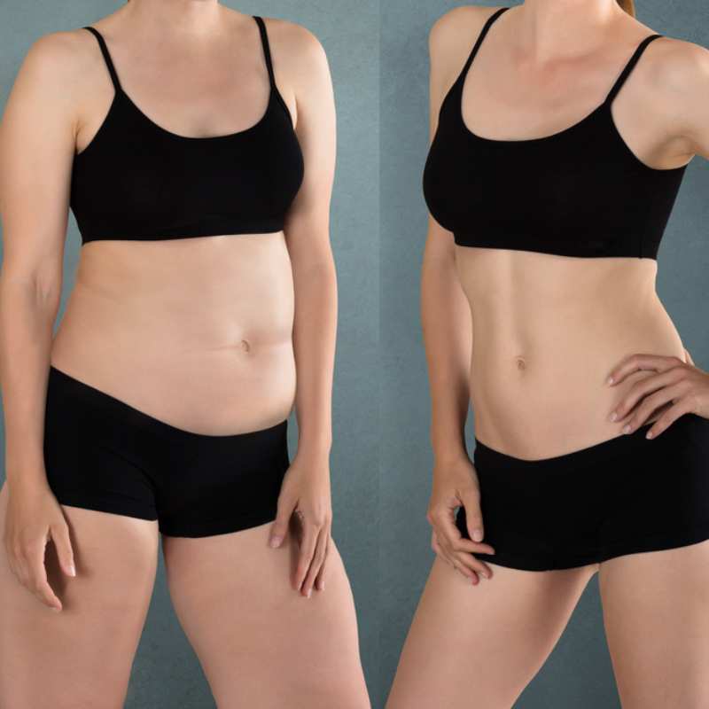 Does Fat Freezing at Home Work? DIY Devices vs Professional Cryolipolysis 2 before and after Cryolipolysis Ruislip Manor