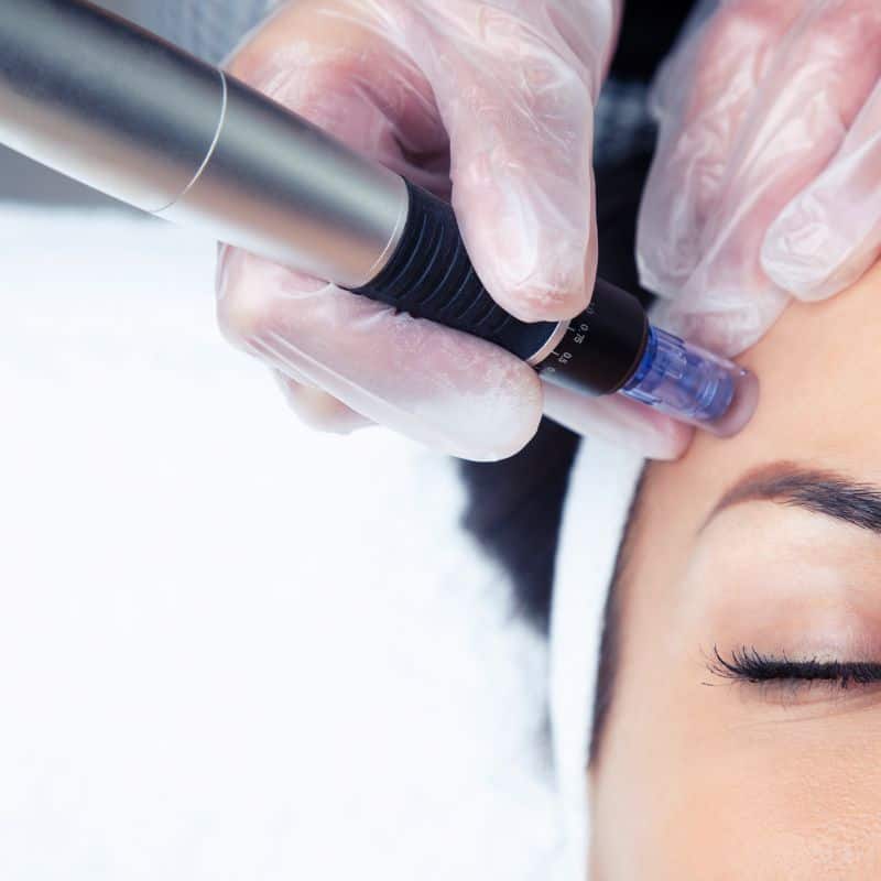 Morpheus8 treatment Ruislip Manor from Lipo Sculpt - Book in today!